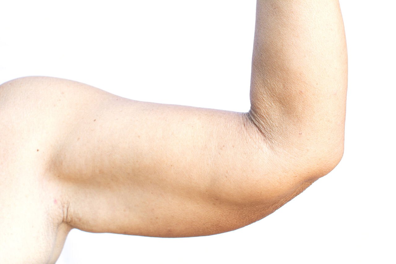 Exercícios não resolvem toda flacidez dos braços: entenda por quê