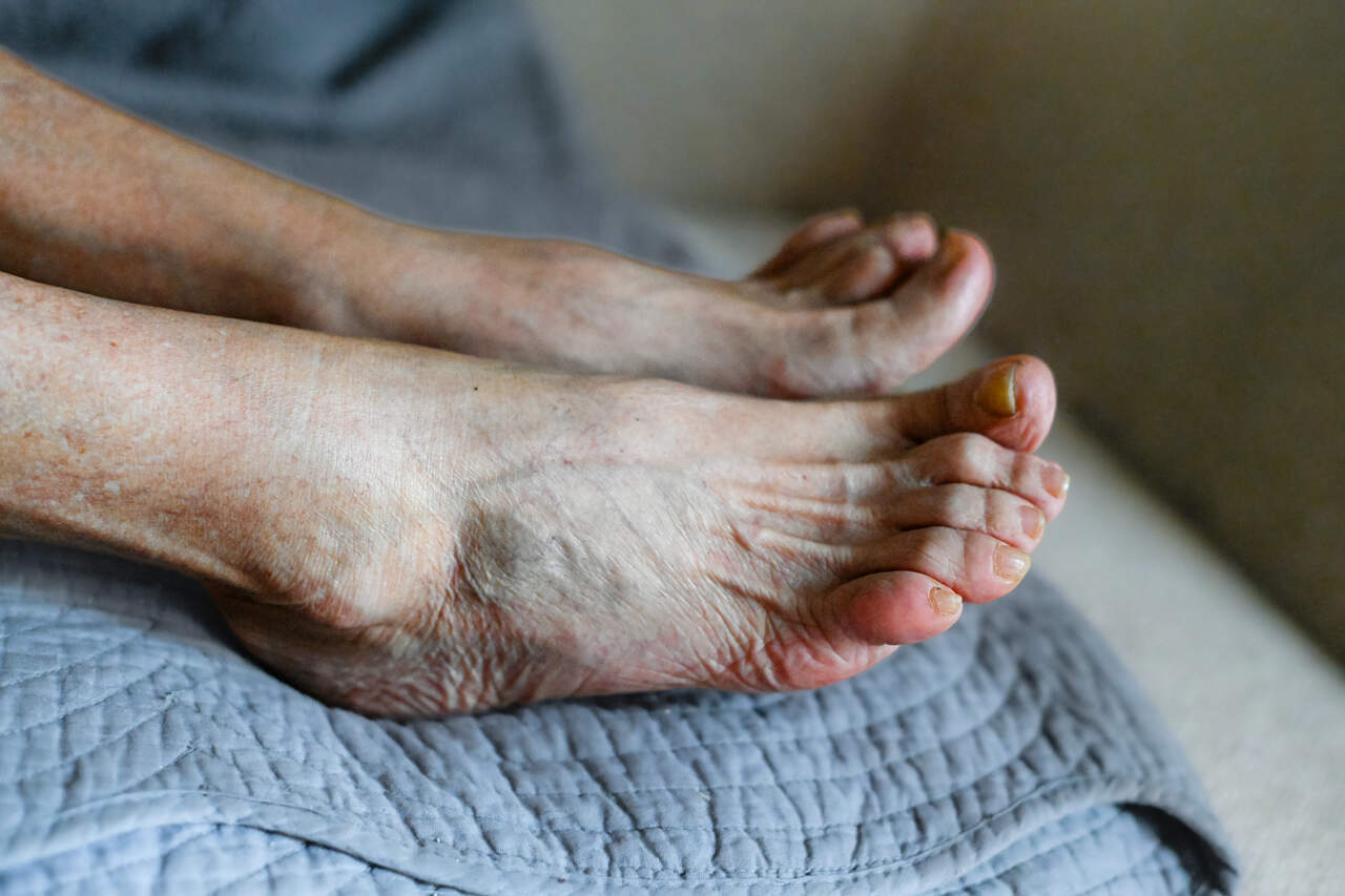 Prevenção do pé diabético pode evitar amputações e internações